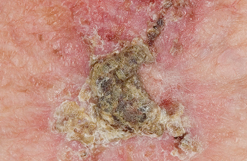 Incanthera -Sol -Melanoma -Image